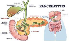 Pancreatitis