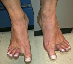 Myosin Storage Myopathy