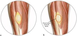 Intramuscular Myxoma